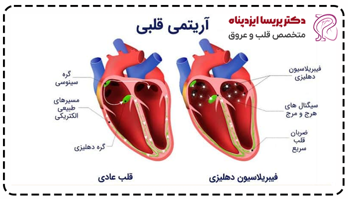 آریتمی قلبی