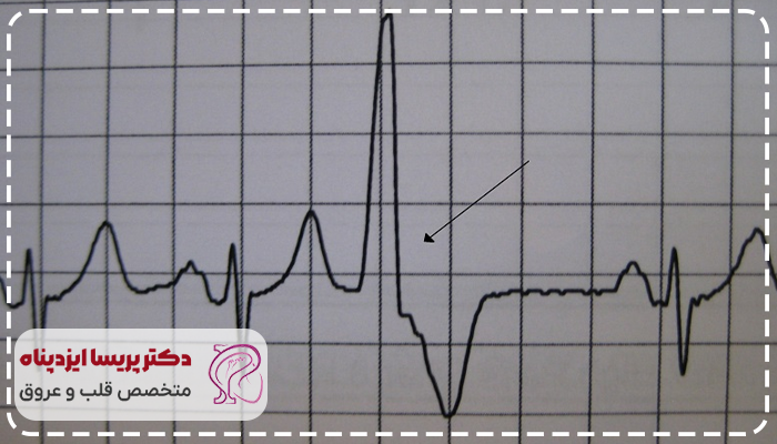 علت پی وی سی قلبی