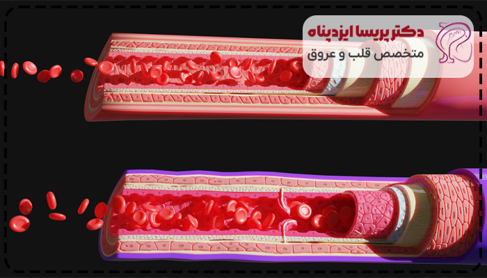 آیا فنر قلب خطرناک است