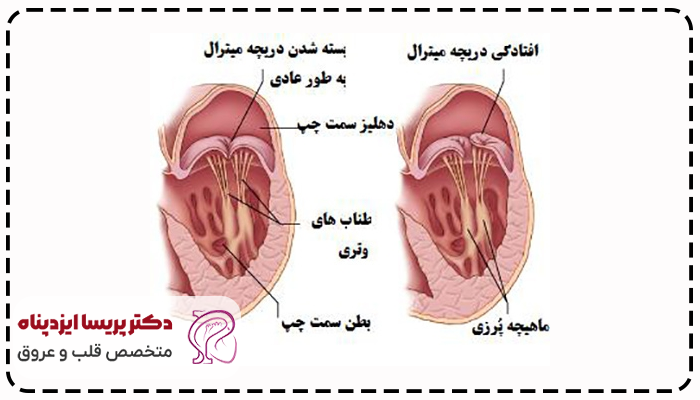 افتادگی دریچه میترال قلب چیست