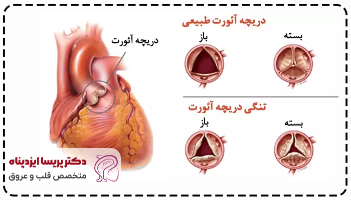 تنگی دریچه آئورت چیست