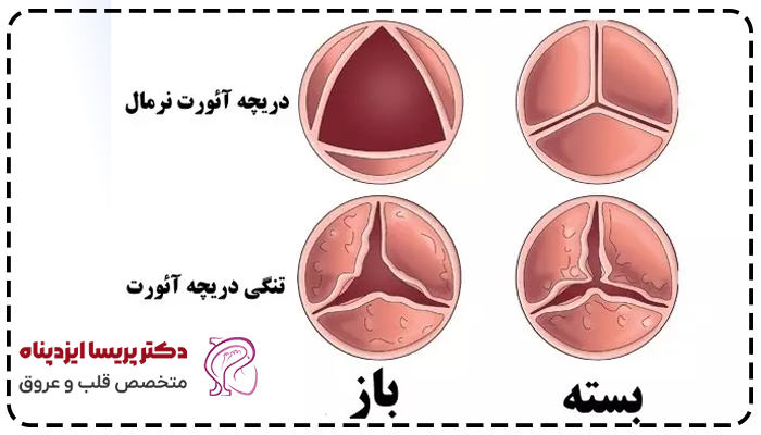 درمان تنگی دریچه آئورت