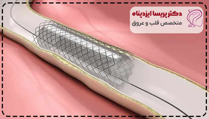 طول عمر فنر قلب