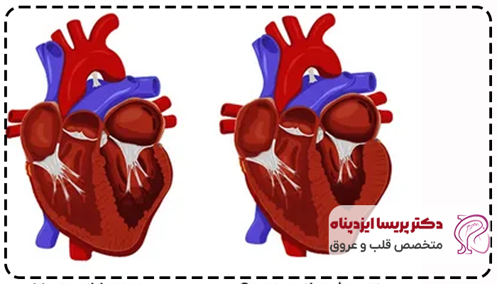 علت نارسایی قلب