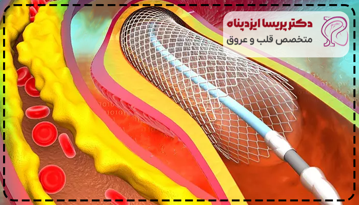فنر زدن قلب