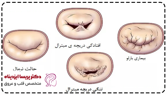 پرولاپس دریچه میترال قلب
