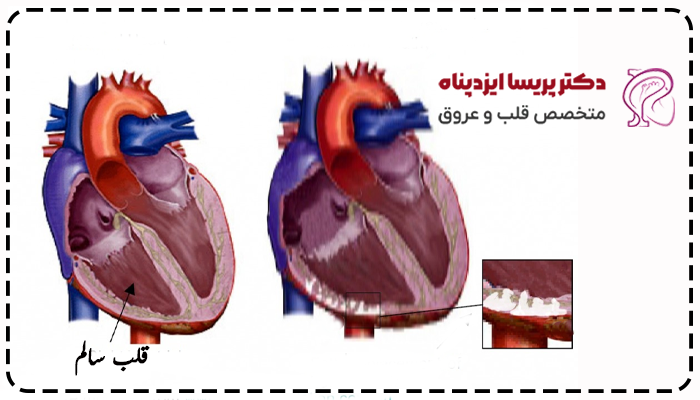 آریتموژنیک بطن راست