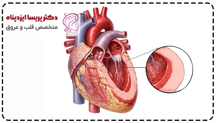 ضخیم شدن دیواره قلب خطرناک است