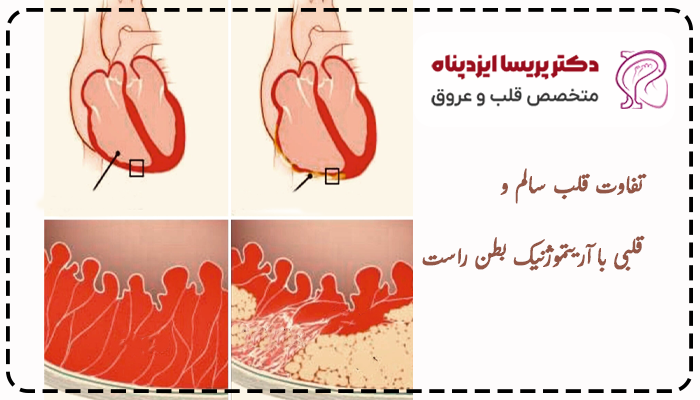 علائم آریتموژنیک بطن راست