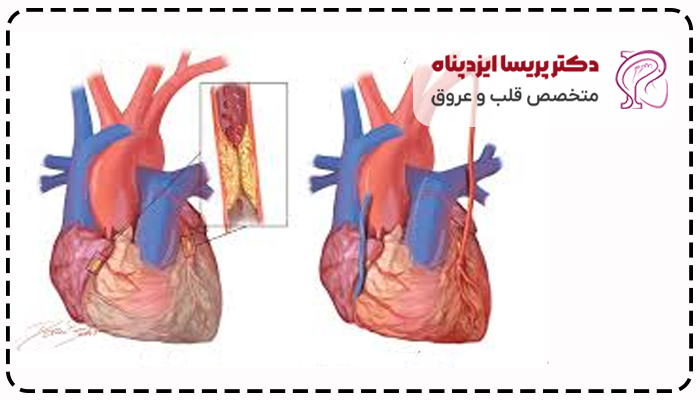 عوارض عمل بای پس قلب