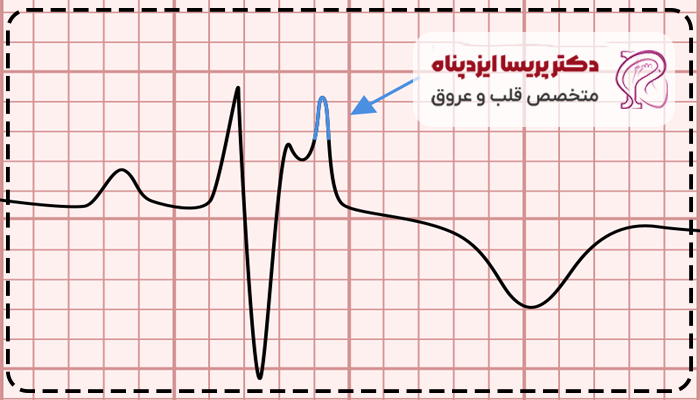 کاردیومیوپاتی آریتموژنیک بطن راست