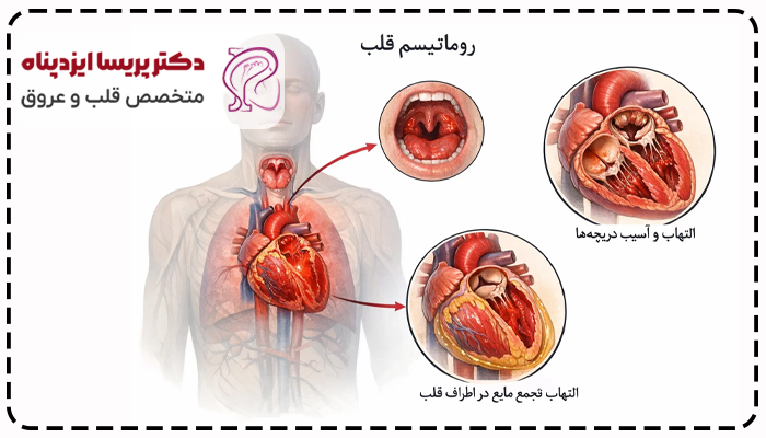 کیا روماتیسم قلبی دارن